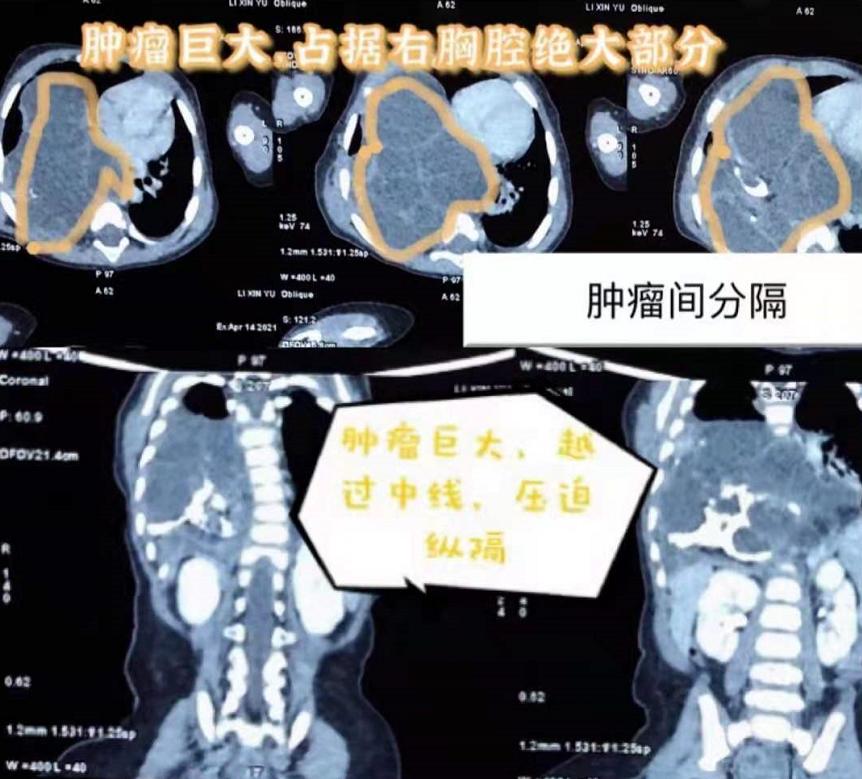 宝宝五个月不爱吃奶的原因及应对策略