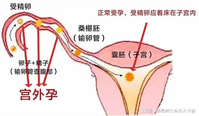 胎盘位置固定的月份及其影响因素