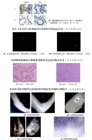 广东省多发型软骨瘤的探究