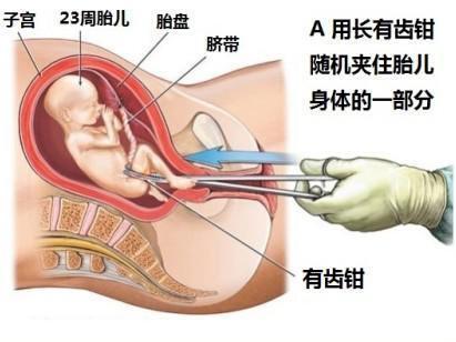 几个月做人流比较好的探讨