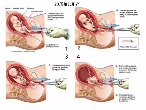 两个月流产伤害的大小，深入了解与关注