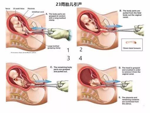 三个月内两次人流，后果与警示